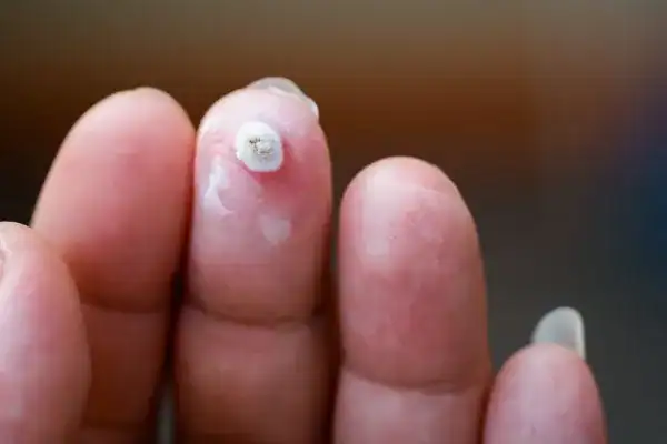 Image of white wart before cryopen treatment Wigan