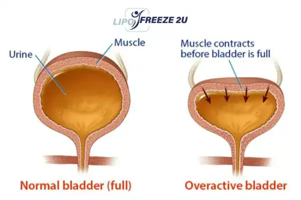 diagram of overactive bladder treatment Wigan