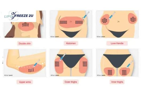 Benefits of Choosing Aqualyx for Fat Reduction Wigan