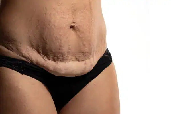 loose skin after weight loss injections Wigan