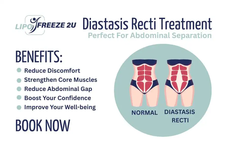 Benefits of body toning treatment Wigan for Diastasis recti