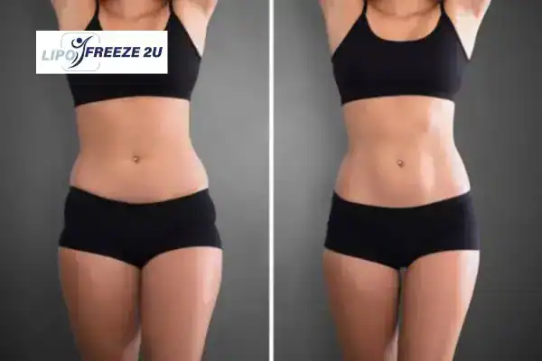 How Can LIPO FREEZE 2U Support Your Post-Pregnancy Body Recovery Wigan?