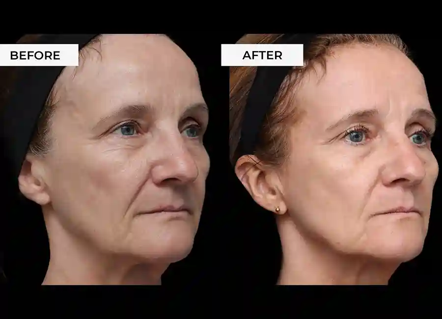How Many RF Microneedling Sessions Will You Need to See a Difference Wigan?